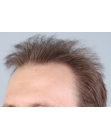 Before Hair Transplant&nbsp;2 Sessions (Areas)